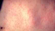 Measles rash with red bumps
